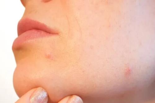 کشف راهی برای خلاصی از شر آکنه ها